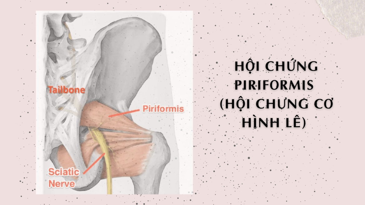 Hội chứng Piriformis - Hội chứng Cơ hình lê